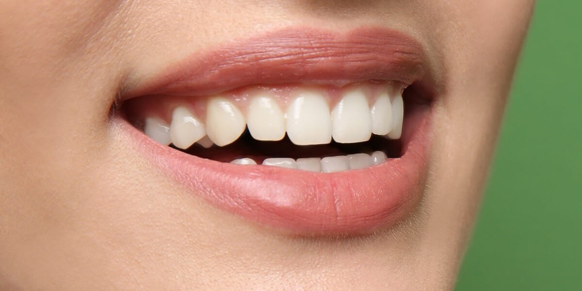 Achieve a Brighter Smile: Teeth Whitening Services in Dubai