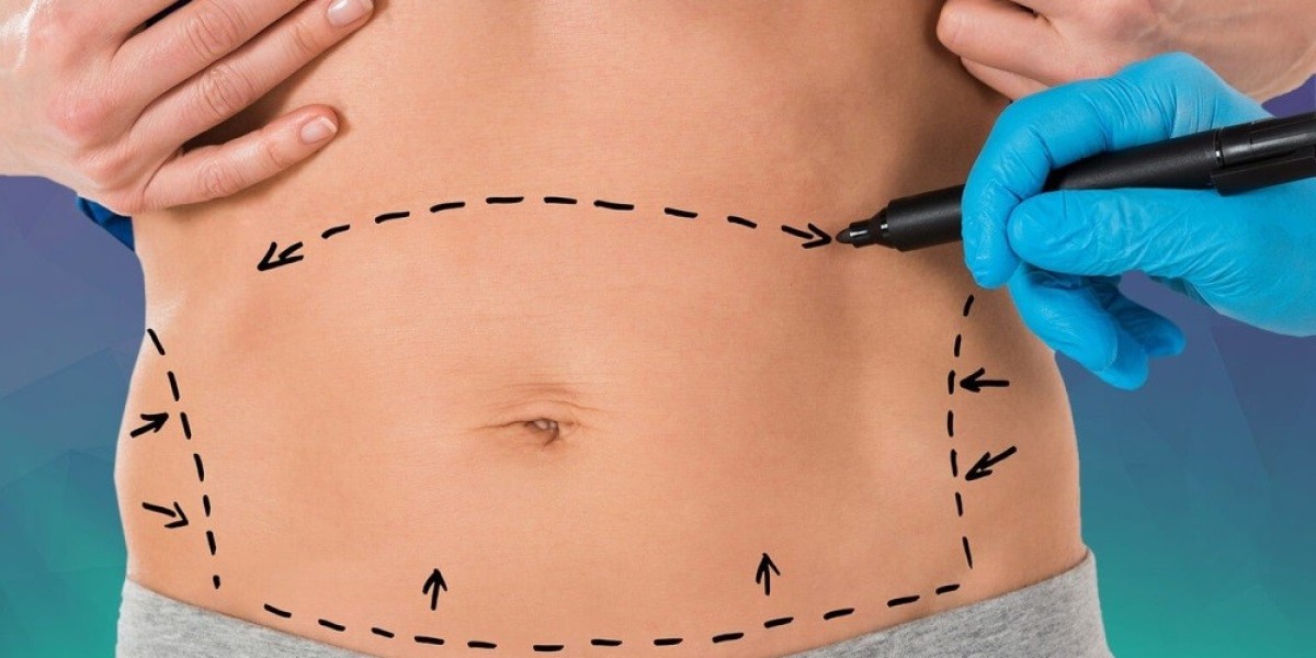 What Areas Can Be Treated with VASER Liposuction in Riyadh?