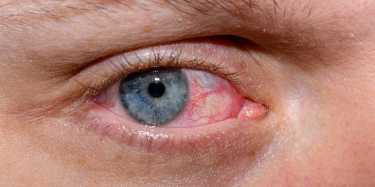 Dry Eye Syndrome Market: Key Growth Factors Driving Treatment Demand