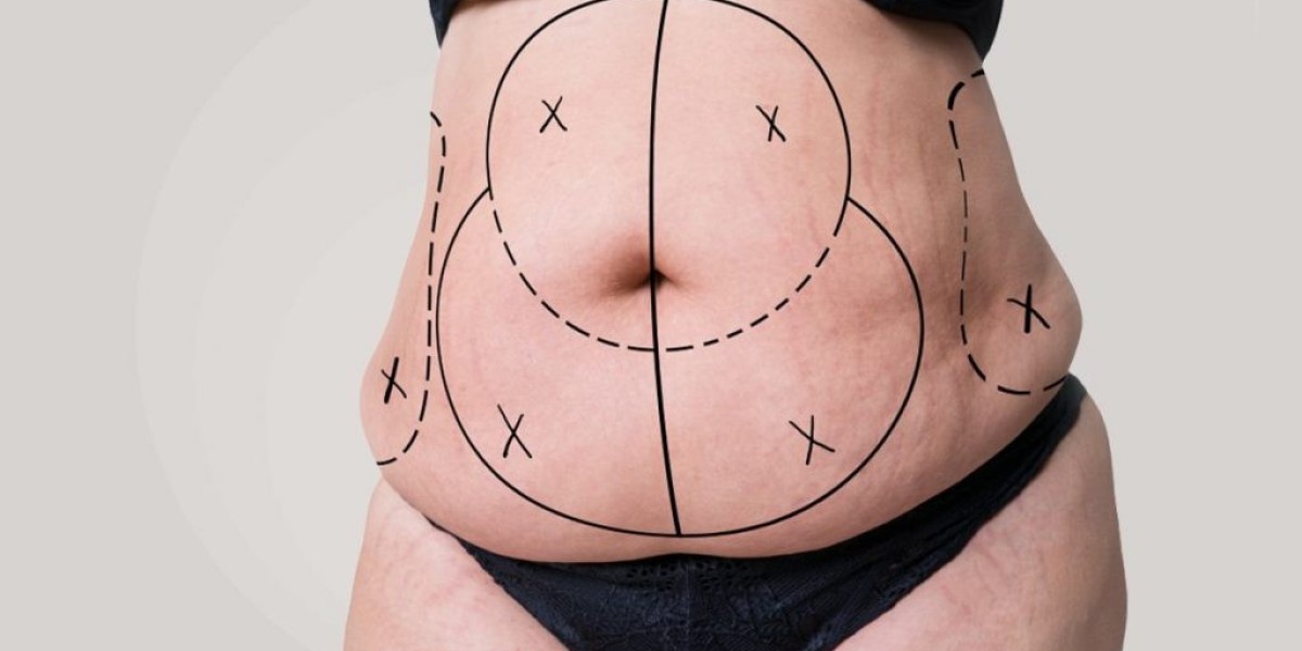 "The Path to a Flatter Stomach Starts with a Tummy Tuck in Riyadh"