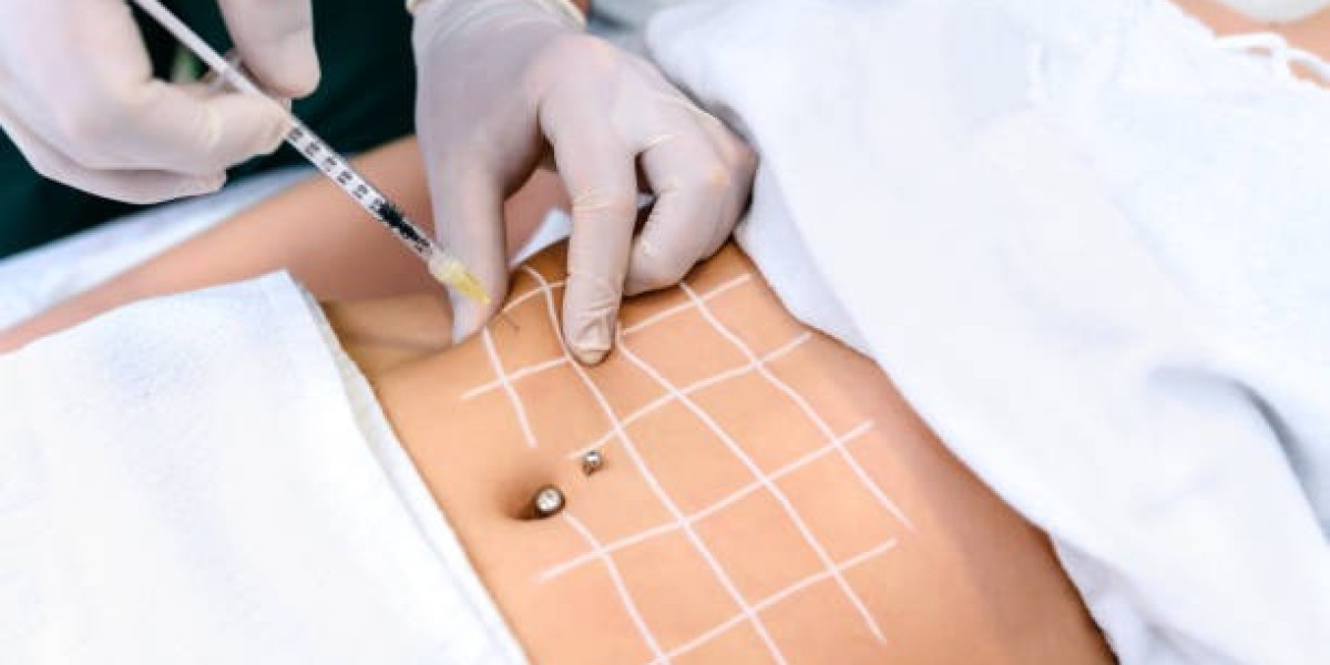 Affordable Liposuction: Discover the Cost in Riyadh