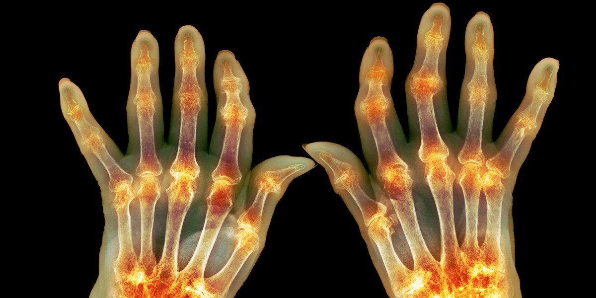 Arthritis Therapeutics Market: Advancing Through Biologics, Technology, and Holistic Care