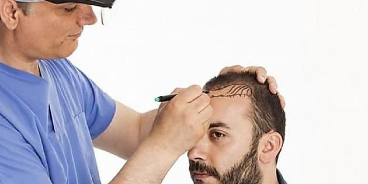 Hair Restoration for Athletes: Maintaining Performance After a Transplant