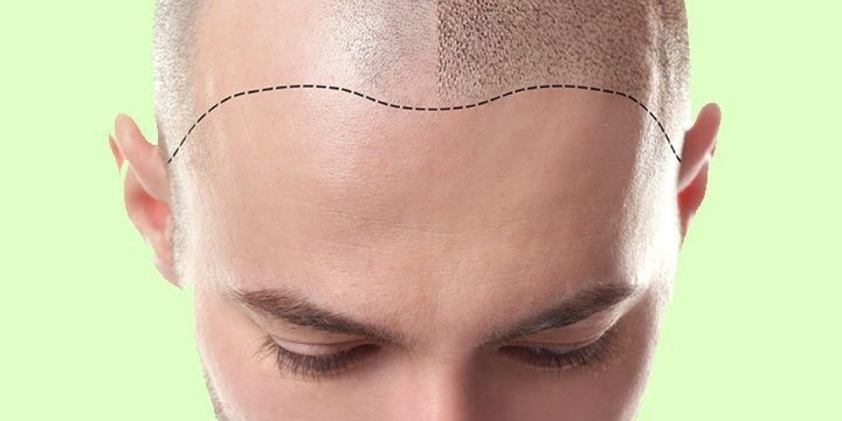 Why Riyadh is Becoming a Hub for Hair Transplants