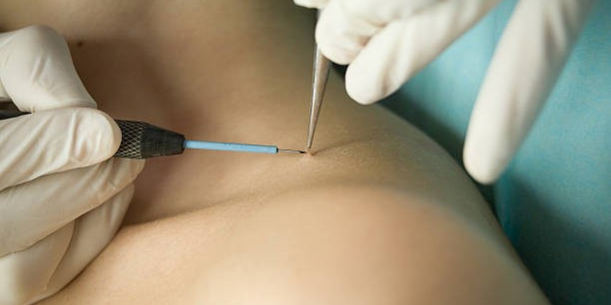 Cryosurgery in Riyadh: Advanced Cryotherapy Techniques for Faster Recovery