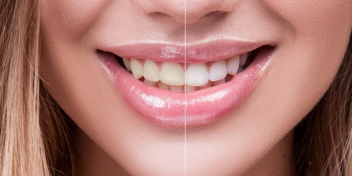 Transform Your Smile with Dubai's Leading Teeth Whitening Options