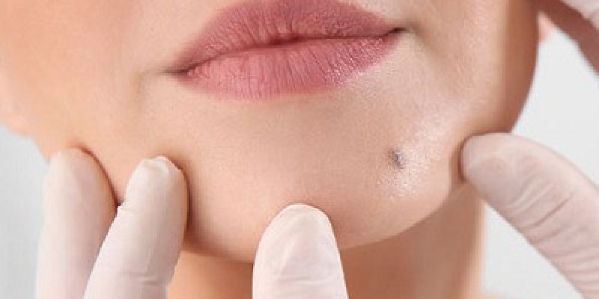 Laser Hair Removal for Beards: A Revolution in Men’s Grooming in Dubai
