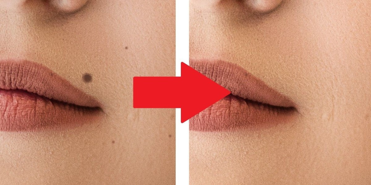 Can Moles Be Removed Permanently? Options in Riyadh