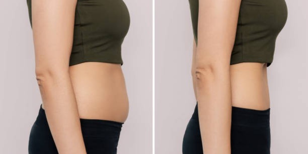 Get the Body You Desire with CoolSculpting in Dubai