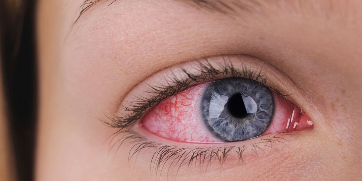 Dry Eye Syndrome Market: Hindrances Shaping Market Dynamics