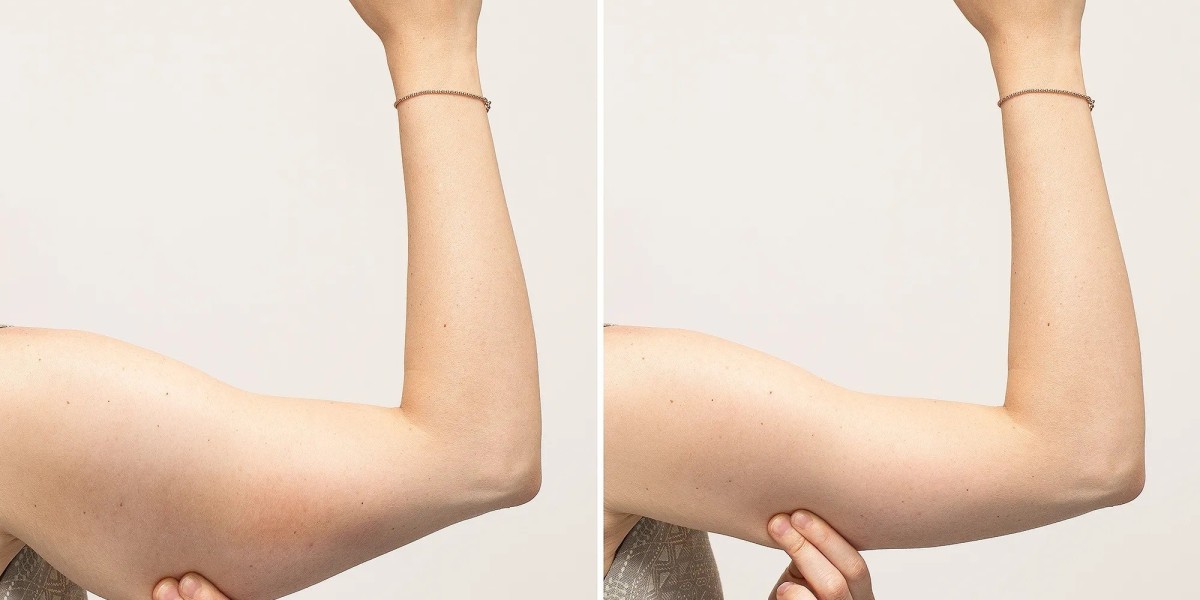 How do I choose the best surgeon for an arm lift?