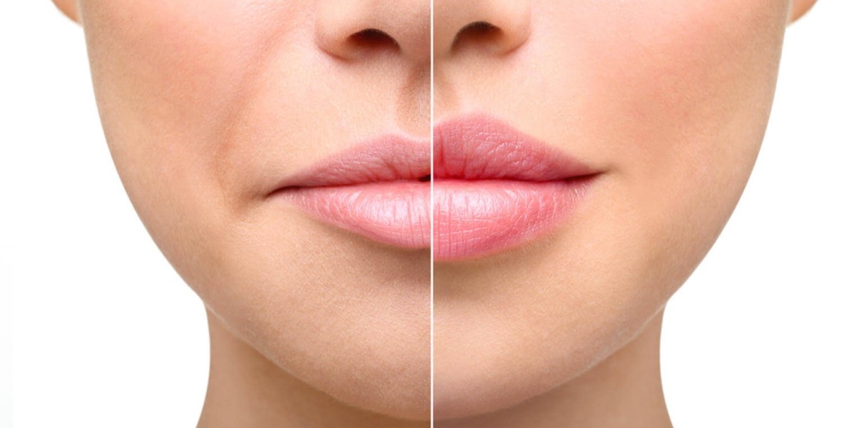Lip Augmentation for Men: Growing Demand in Riyadh