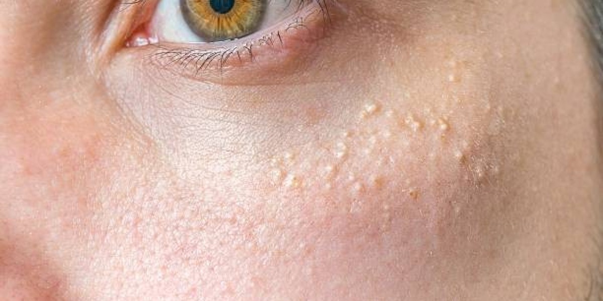 Milia in Riyadh: How to Treat and Prevent It for Glowing Skin