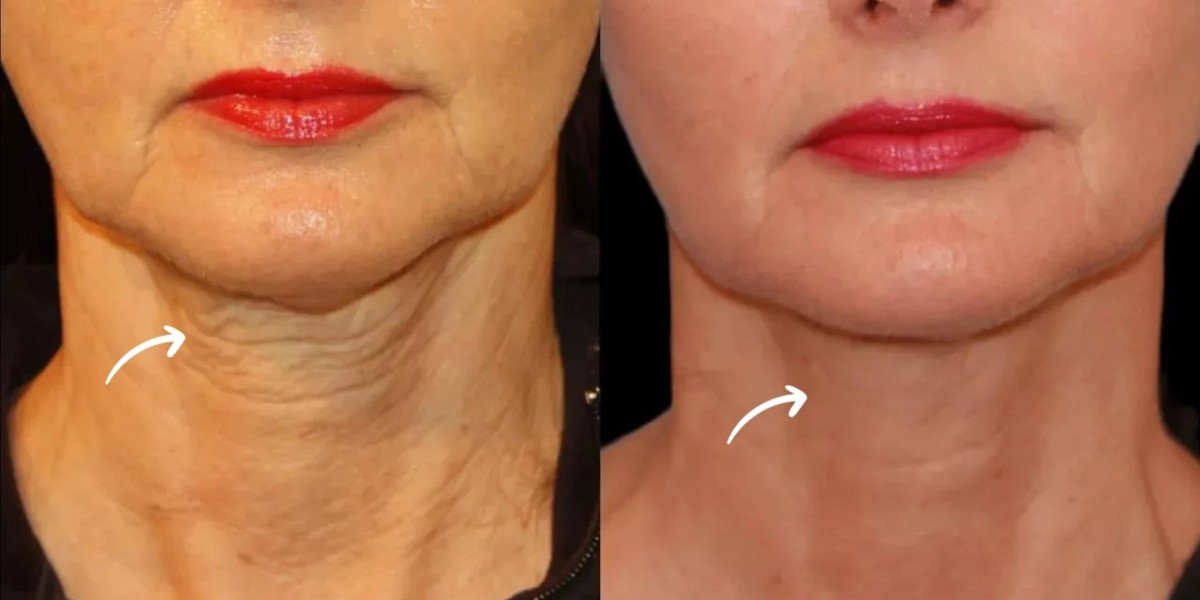 What Makes the Best Sculptra Dermatologists in Dubai Stand Out?