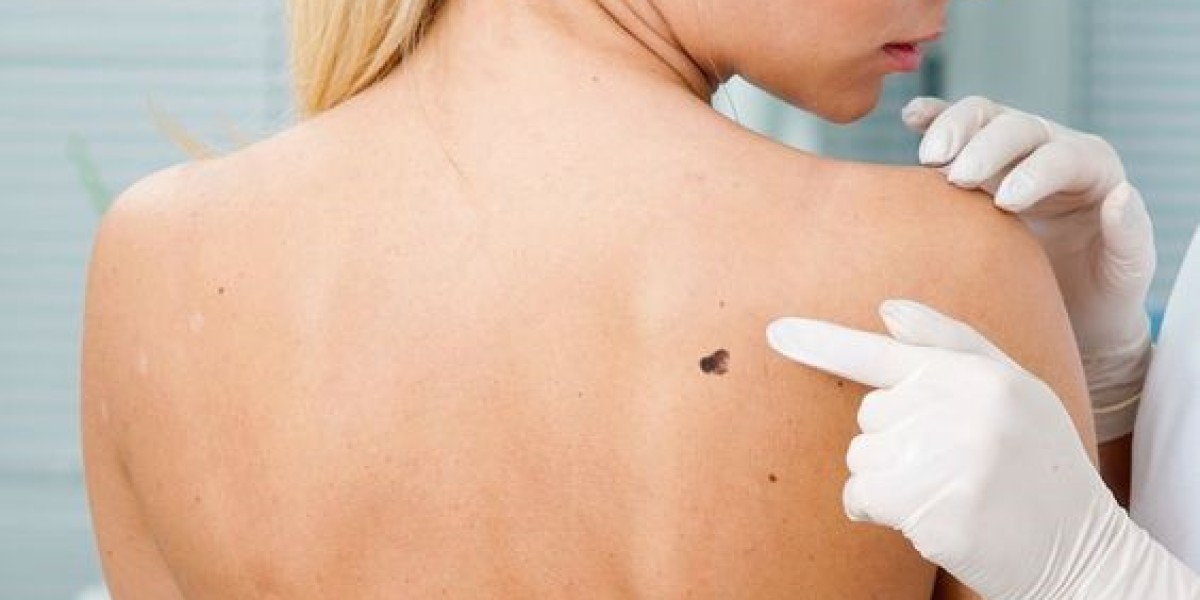 خبراء التجميل يكشفون أفضل طرق علاج إزالة علامات الجلد