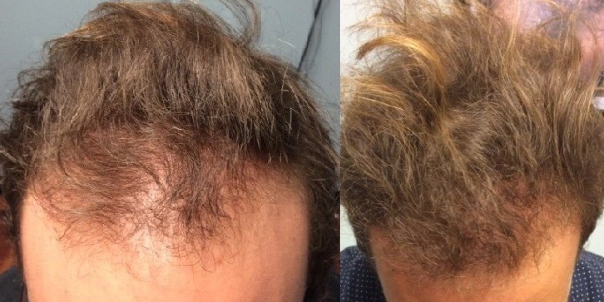 The Science Behind Stem Cell Hair Transplants Available in Riyadh