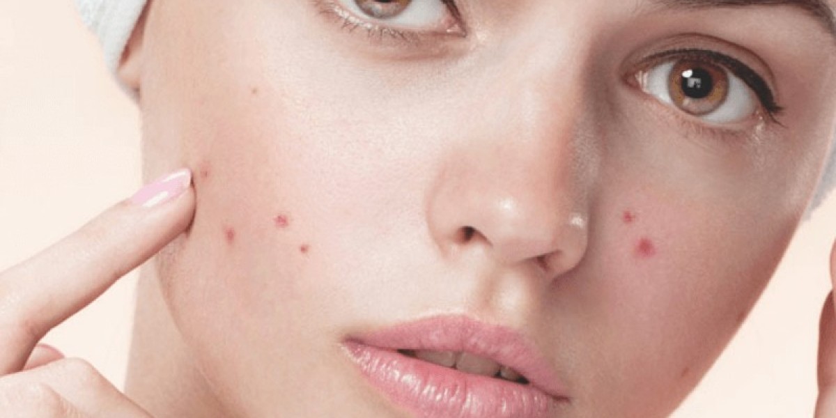 Facial Treatments for Pimples-Free Skin in Riyadh