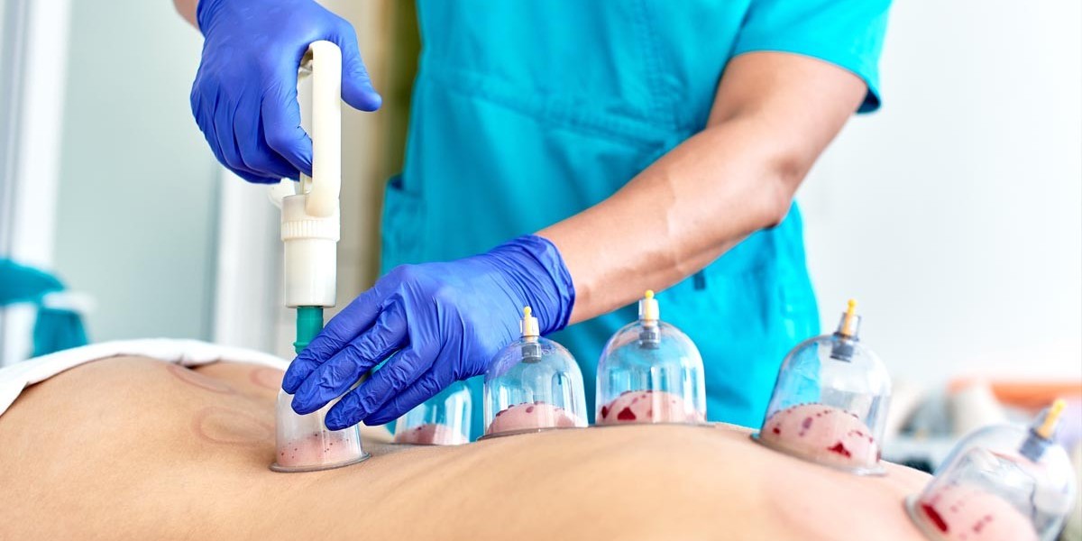 The Role of Hijama Cupping Therapy in Modern Alternative Medicine