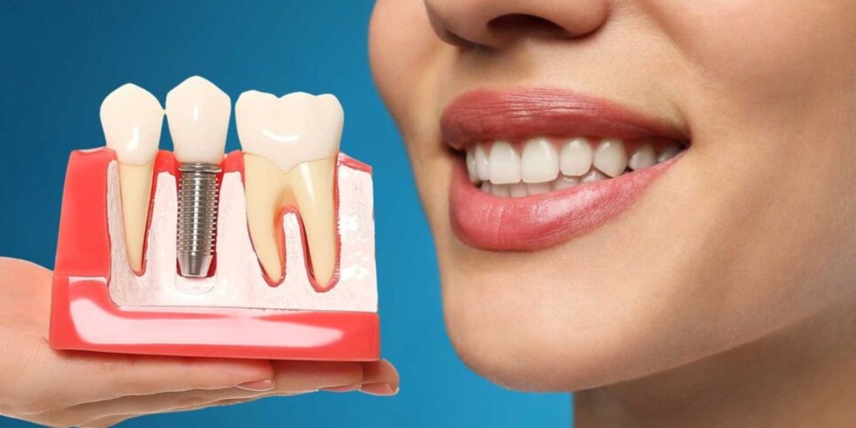 Say Goodbye to Gaps: Discover the Power of Dental Implants