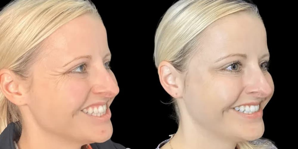 Why Botox is a Must at the Best Aesthetics Clinic in Dubai