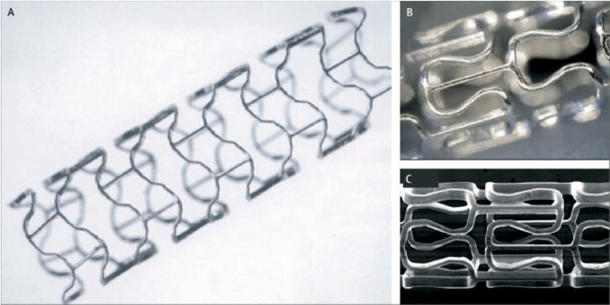 Germany’s Stents Market Innovations, Growth Drivers, and Future Trends