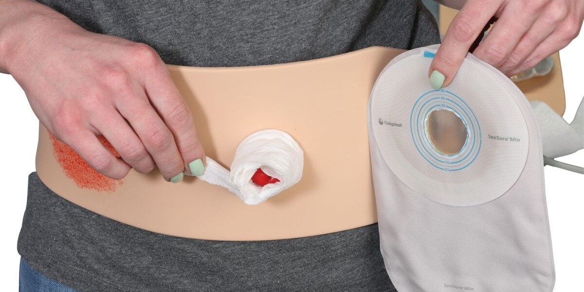 Ostomy Devices Market: Recent Developments in Technology and Patient Comfort