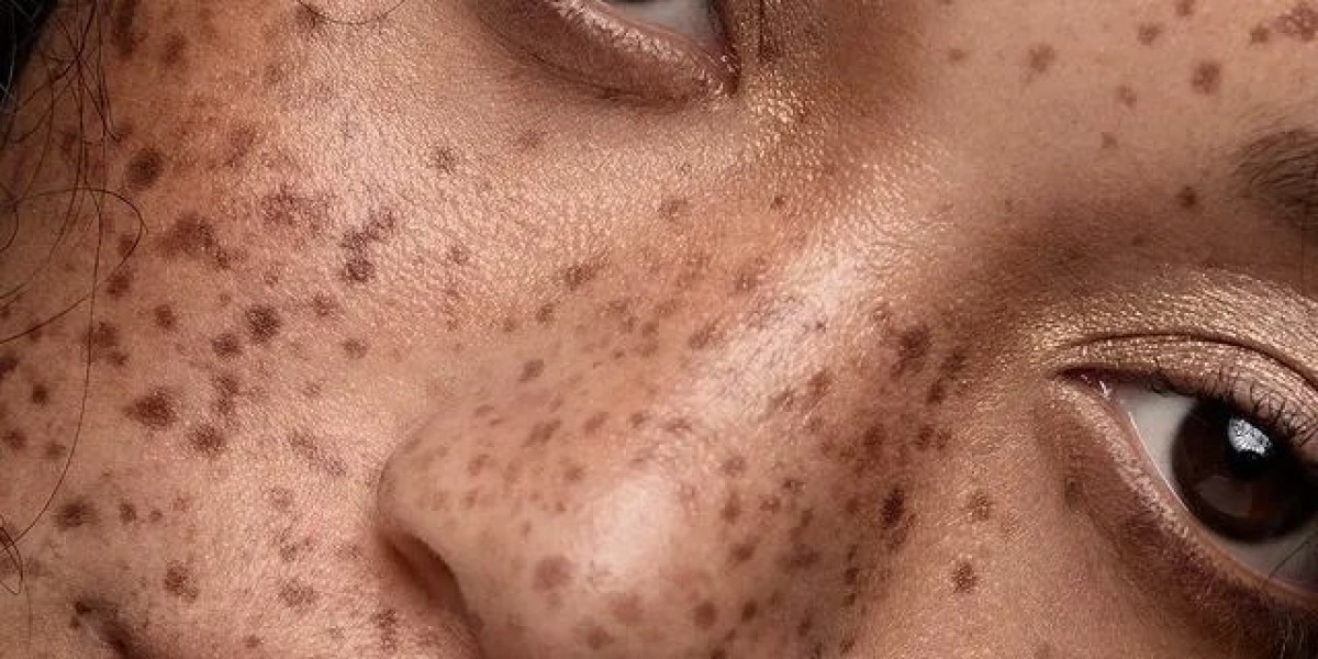 Understanding Dermal Pigmentation in Islamabad: Causes and Solutions