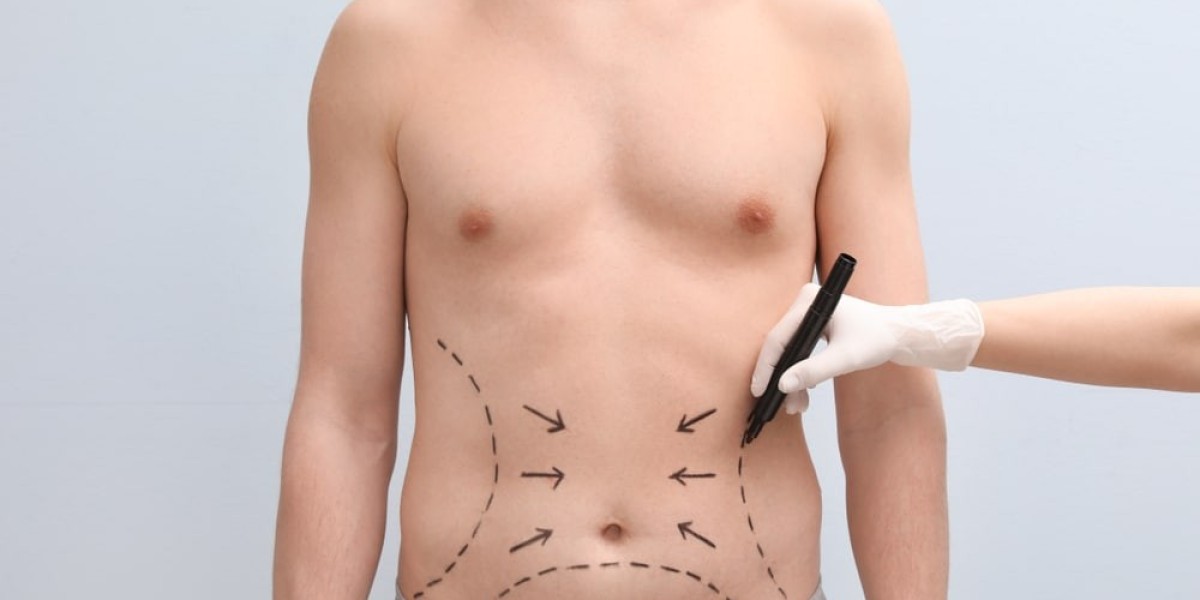 Patient Testimonials: Real Stories of Liposuction Surgery in Riyadh