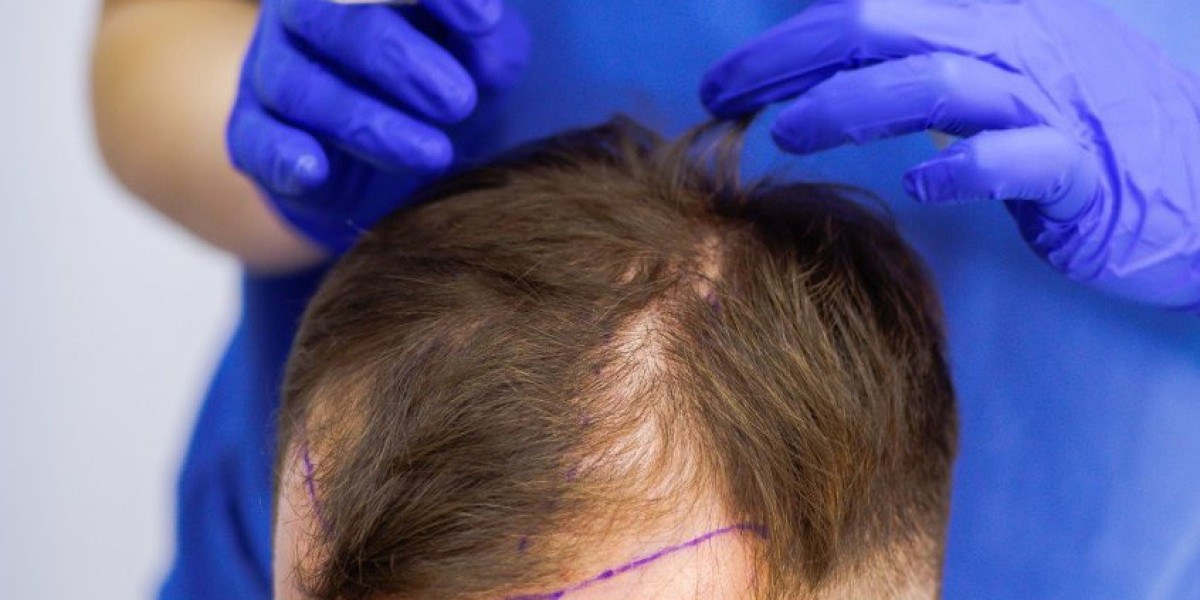 Stem Cell Hair Transplant Recovery Tips from Riyadh Specialists