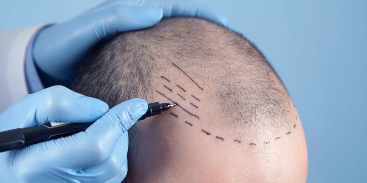 Hair Transplant Cost Breakdown: Riyadh's Options