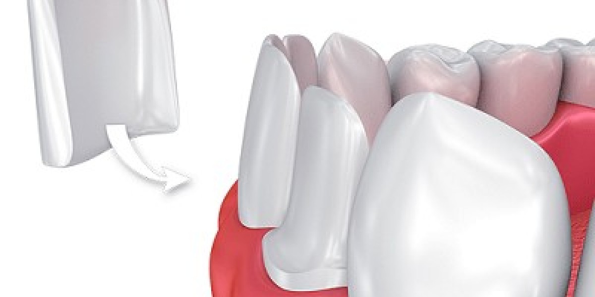 Why Composite Veneers Are the Ultimate Smile Solution in Dubai