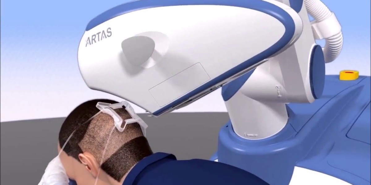 Revolutionizing Hair Restoration: Robotic Hair Transplant in Islamabad