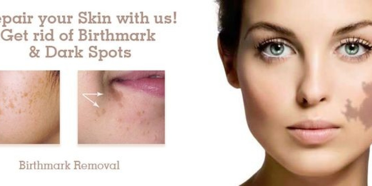 Before and After: Birthmark Removal in Riyadh