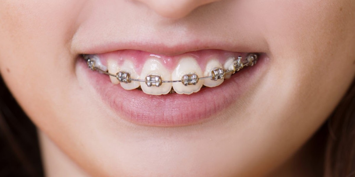 The Role of Teeth Braces in Achieving a Perfect Smile