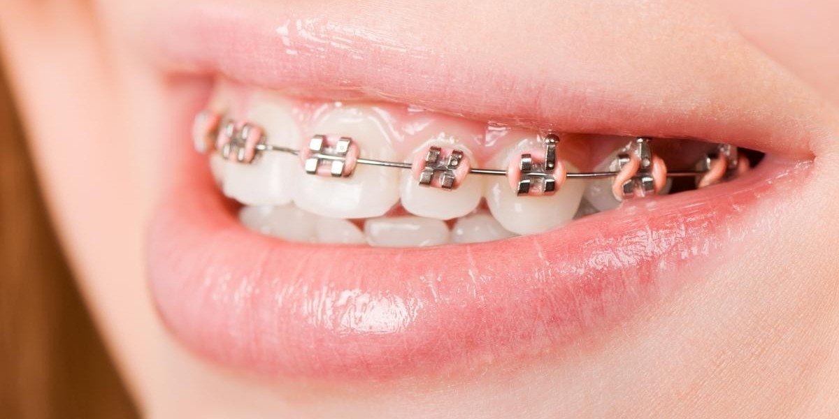 How to Care for Your Teeth Braces: A Comprehensive Guide