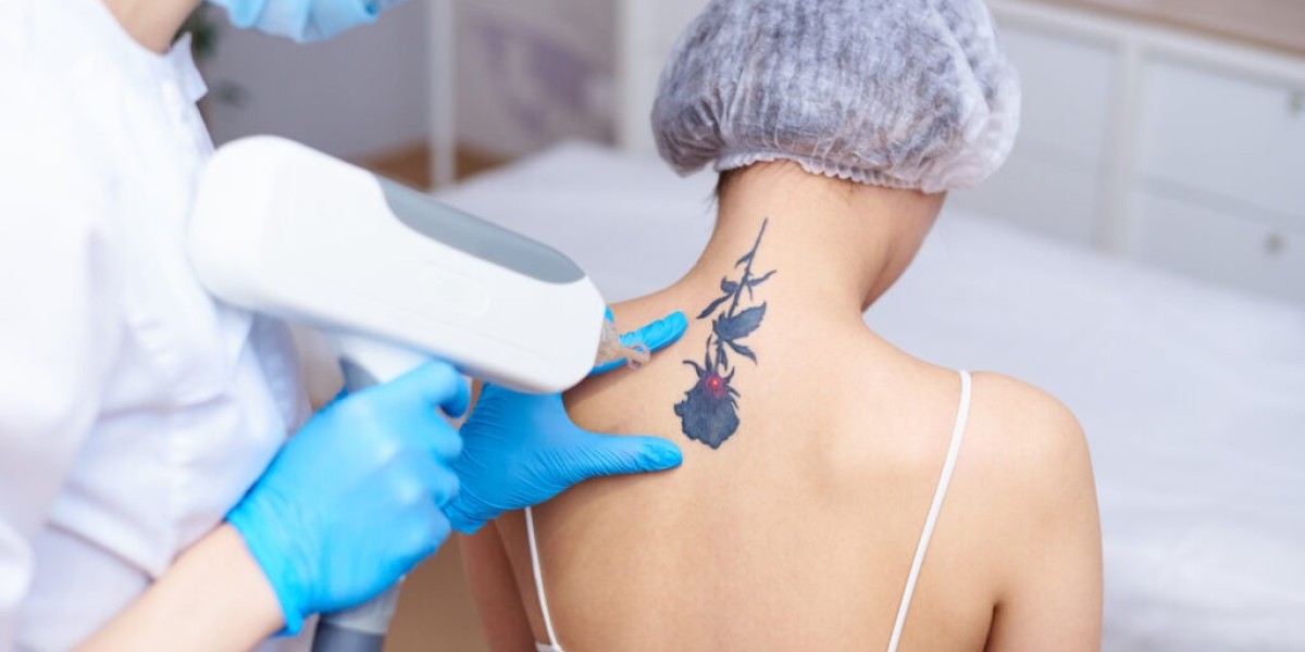 The Most Effective Laser Treatments for Tattoo Removal in Dubai