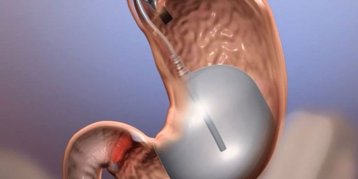 Transform Your Waistline: Gastric Balloon in Riyadh