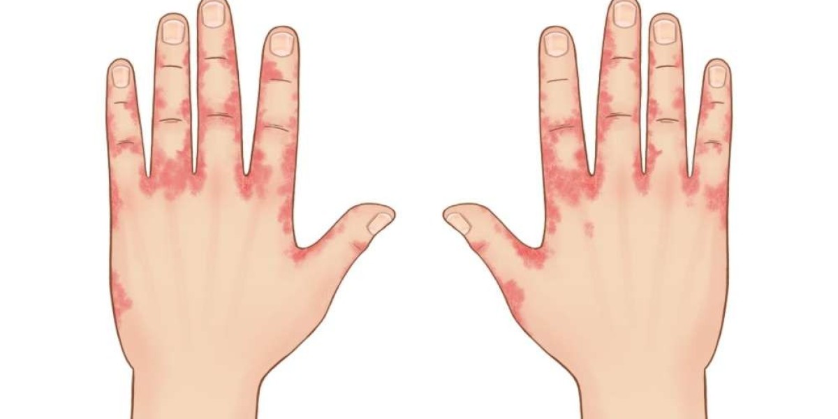 Atopic Dermatitis Market: New Players and Strategic Shifts in a Growing Industry