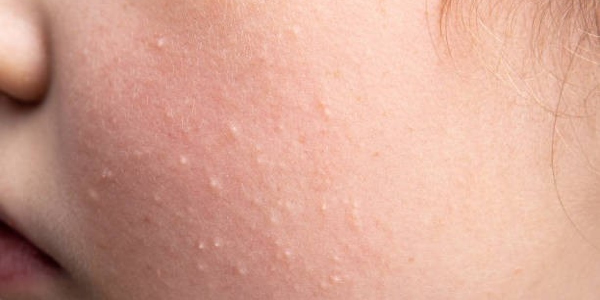 What is Milia Treatment?