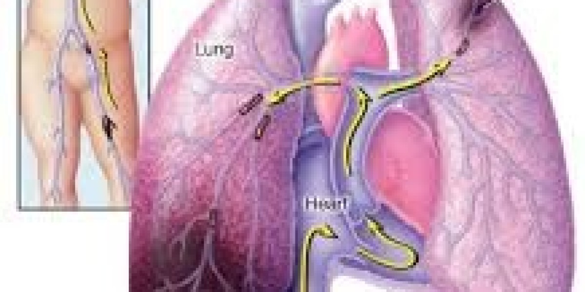 Exploring the United States Pulmonary Embolism Market: Trends and Innovations