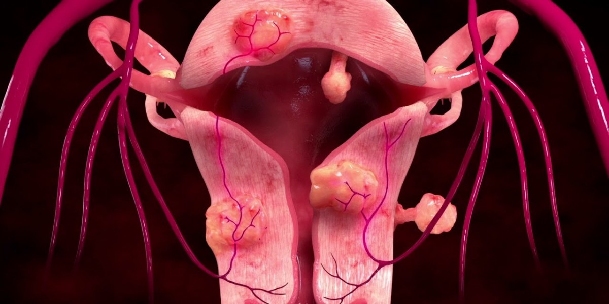 Uterine Fibroid Treatment Market: Insights into Regulatory Changes, Health Policies, and Impact on Market Growth