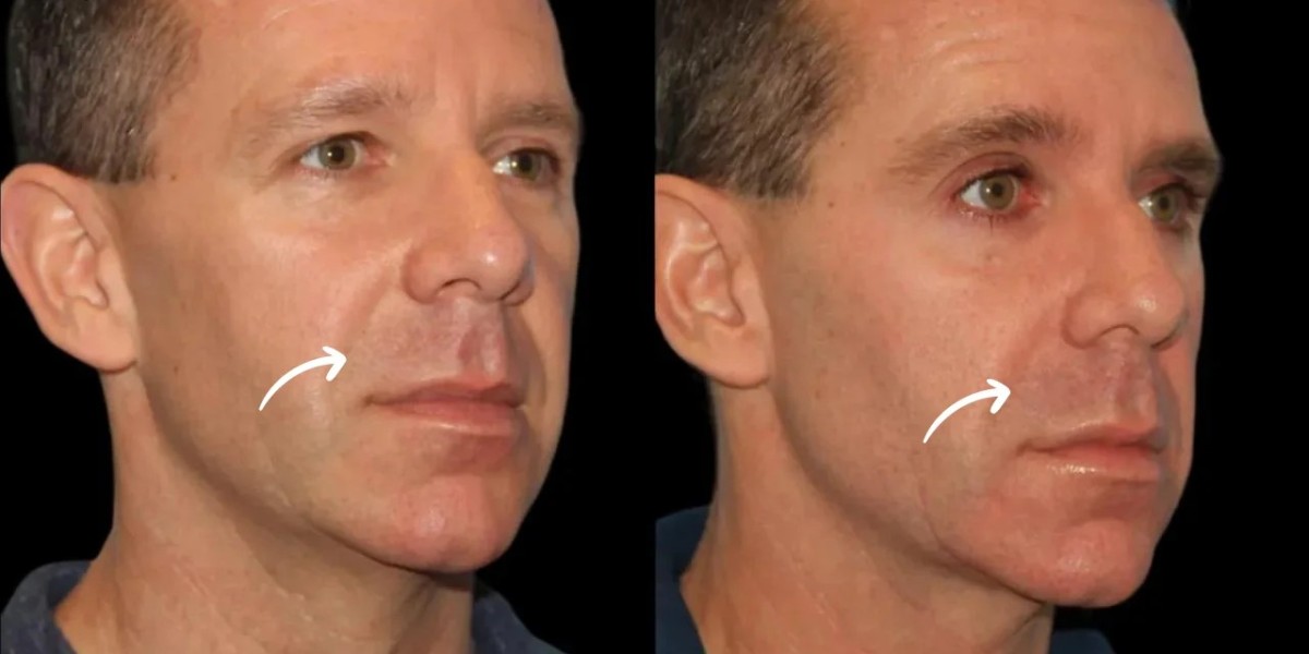 Sculptra at the Best Aesthetic Clinic in Dubai: What to Know