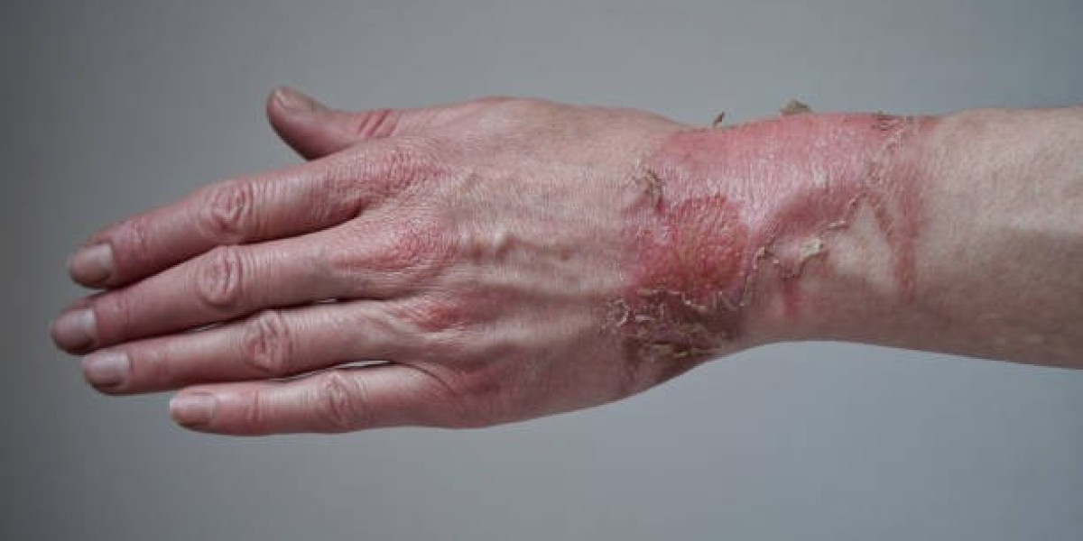 هل يغطي التأمين تكلفة عملية تجميل آثار الحروق؟