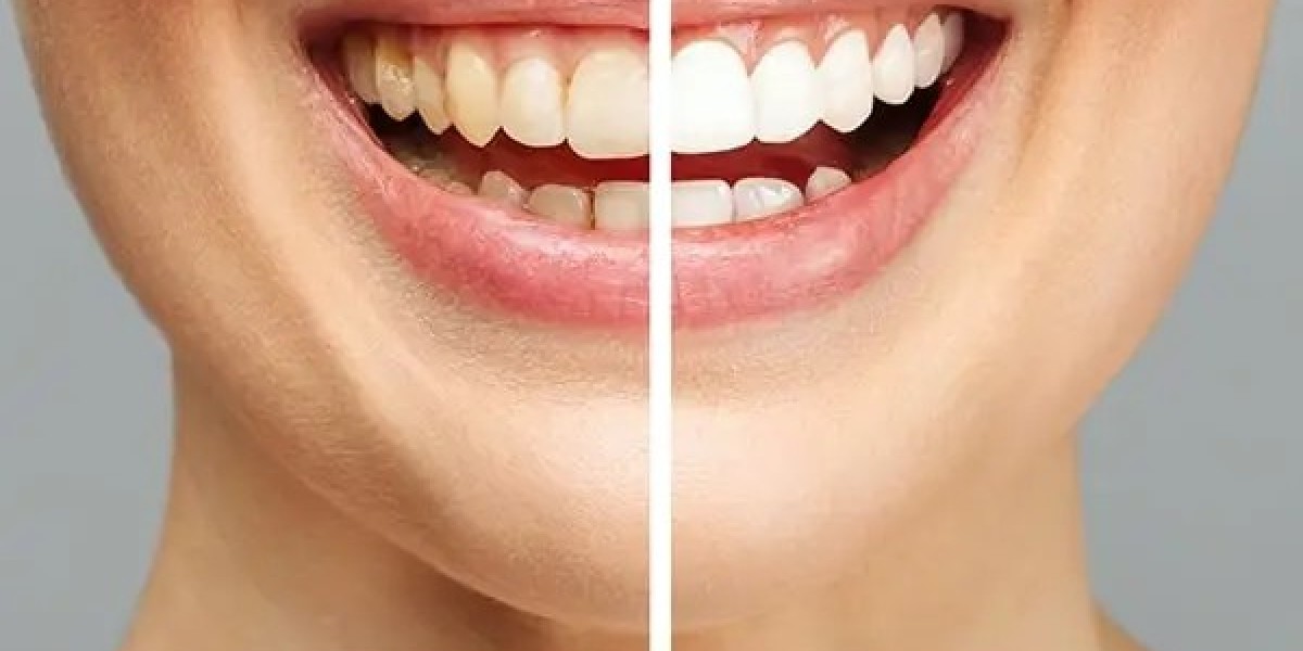 Effective Teeth Whitening Solutions in Dubai: Achieve a Brighter Smile