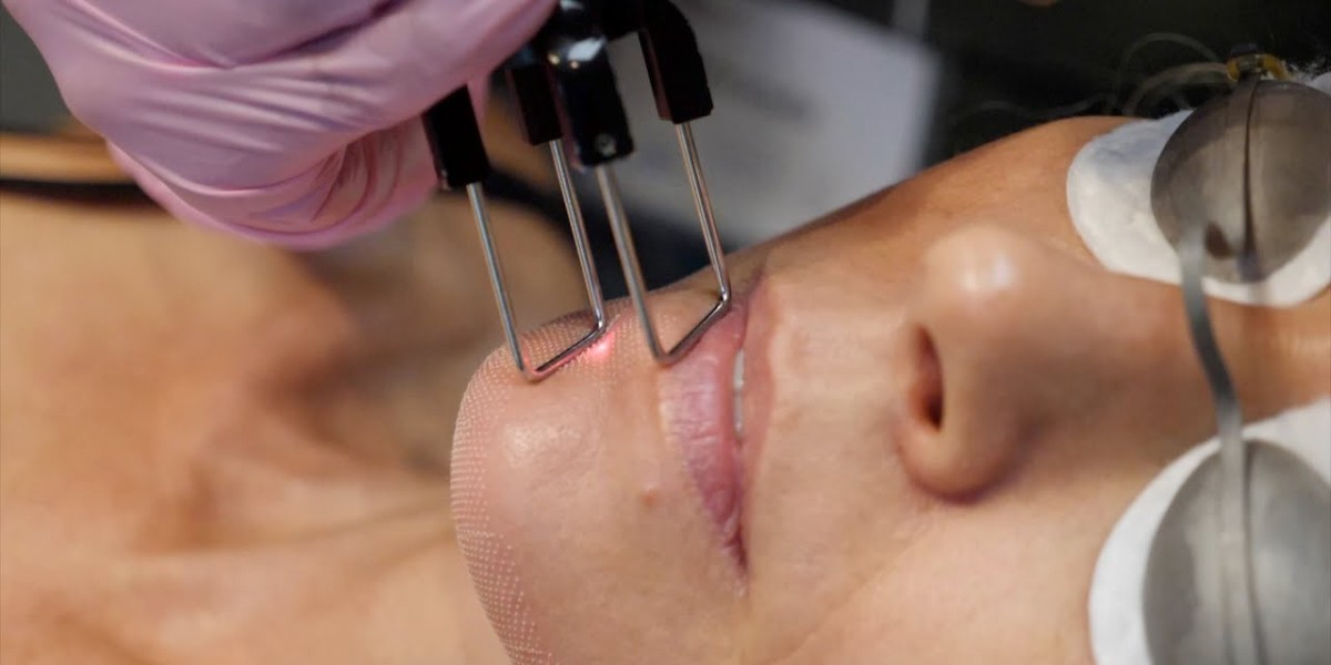Beauty Beyond Expectations: Fractional CO2 Laser for Youthful Skin at a Reasonable Price in Dubai