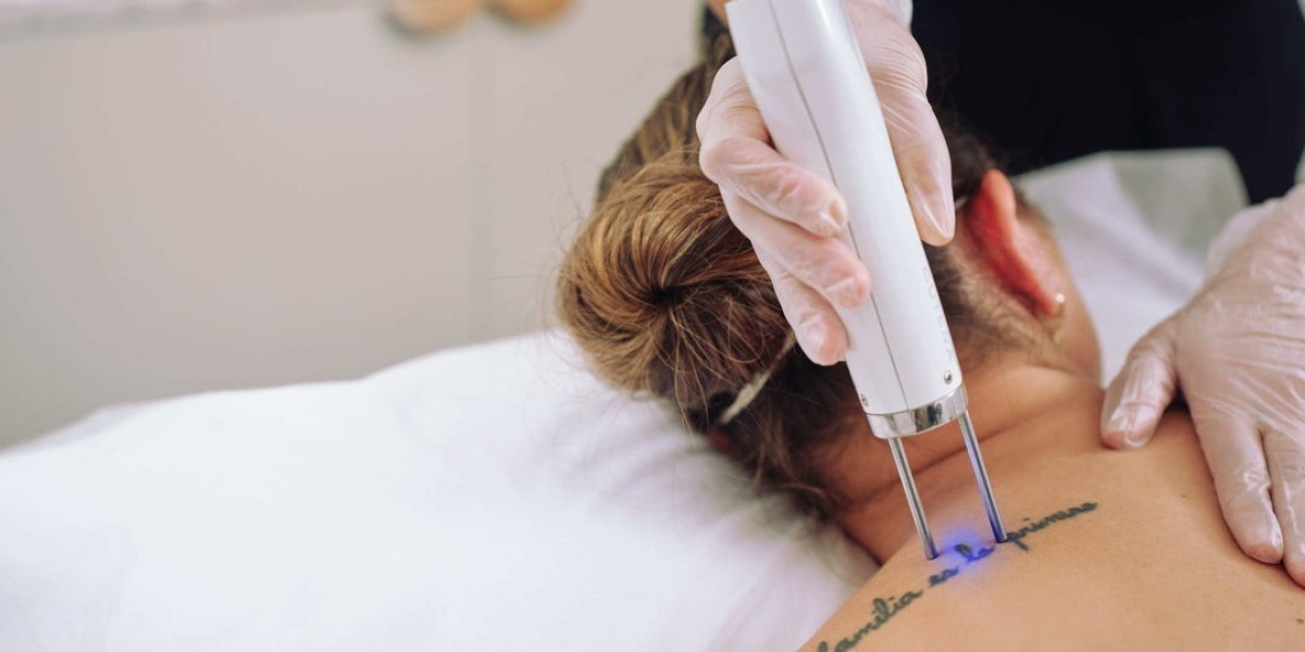 Laser Tattoo Removal Myths Debunked: What You Need to Know in Dubai