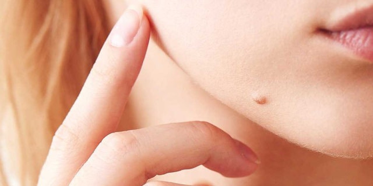Exploring Advanced Techniques for Skin Tag Removal in Dubai