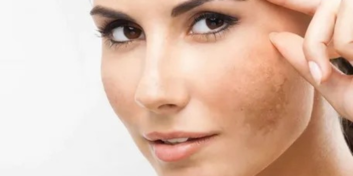 Effective Melasma Treatments in Islamabad: What You Need to Know