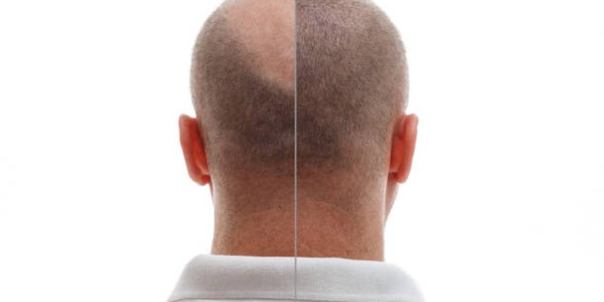 استعد ثقتك بزراعة الشعر في الرياض