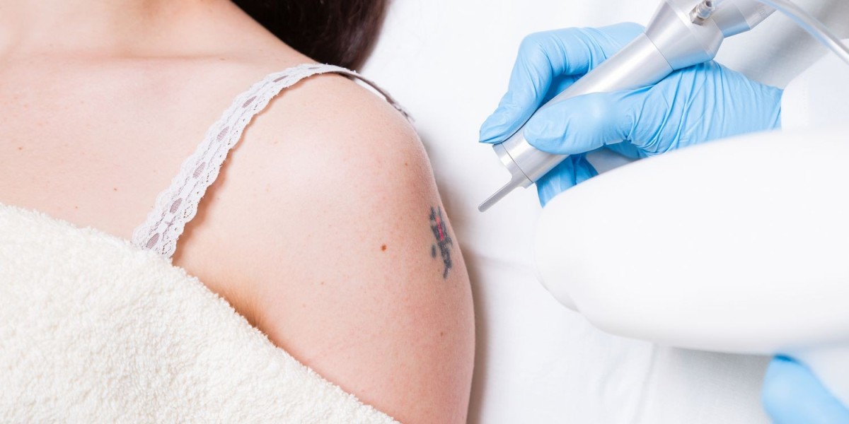 Guide to Laser Tattoo Removal Results in Riyadh